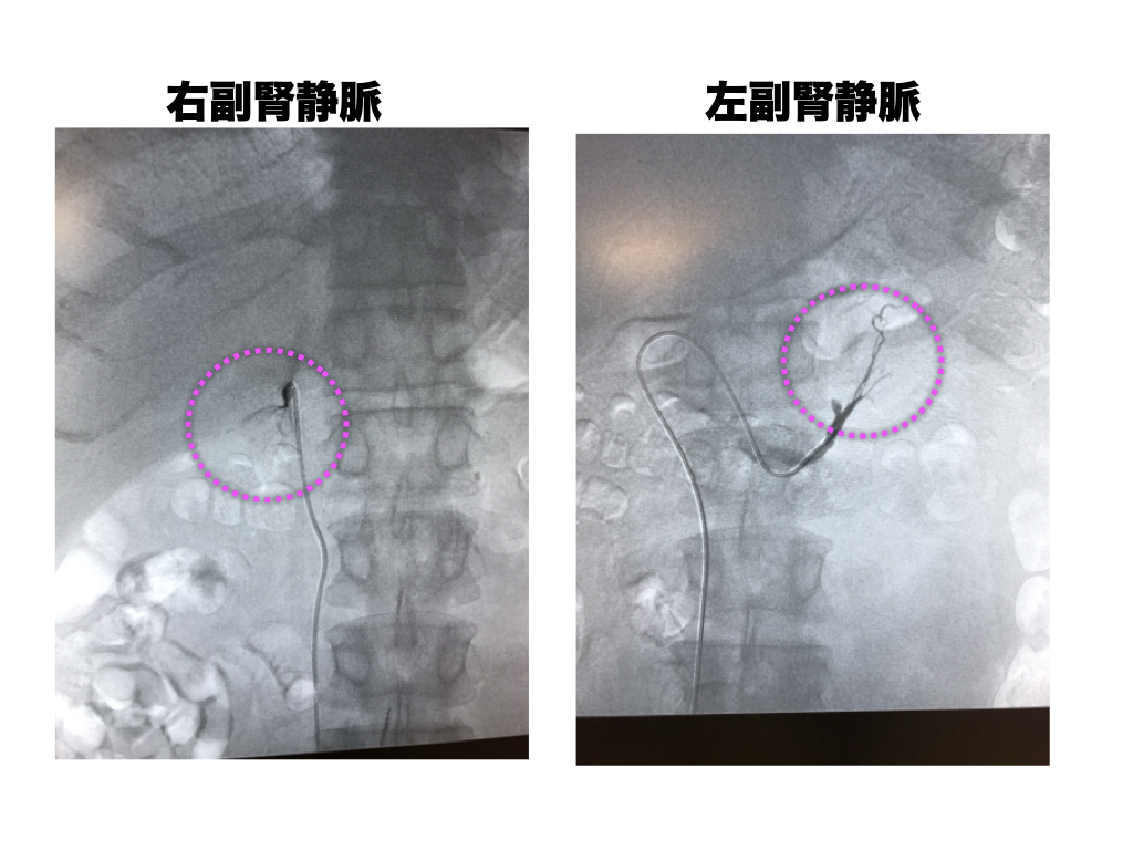 副腎静脈サンプリング(AVS)透視像：右副腎静脈（左）と左副腎静脈（右）へのカテーテル留置。ピンクの点線円がカテーテル先端位置を示す。